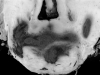 Primary pontine hemorrhage in a patient with acute promyelocytic leukemia